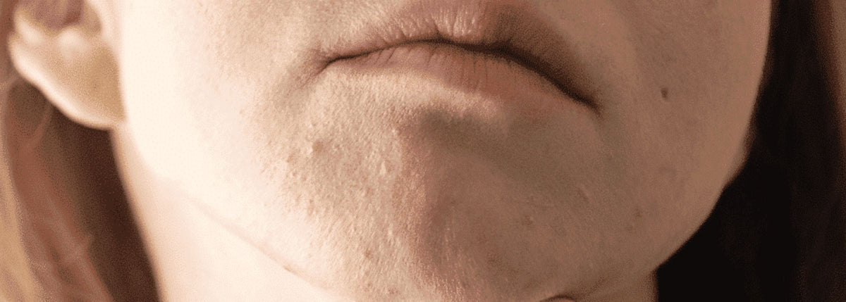 Imperfections hormonales : la sélection de compléments alimentaires et soins bio MiYé