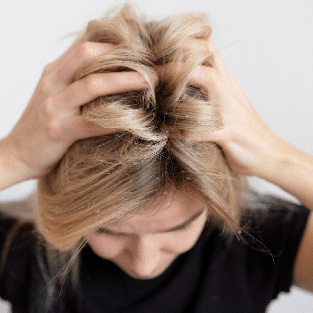 Perte de cheveux