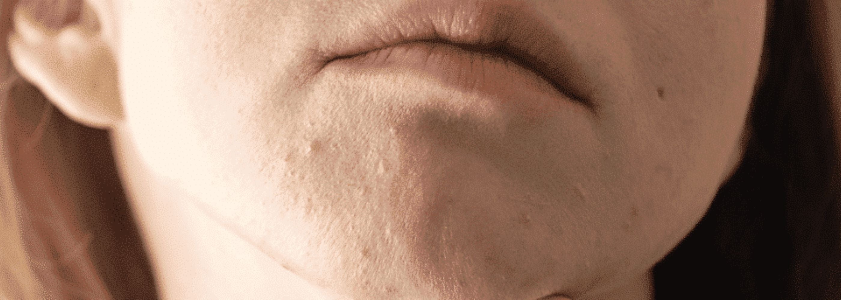 Imperfections hormonales