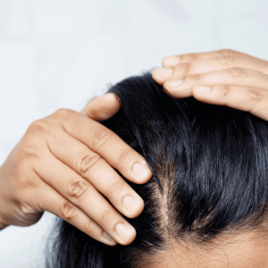 perte de cheveux