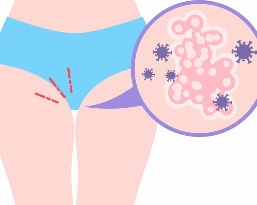 Probiotique microbiote vaginale