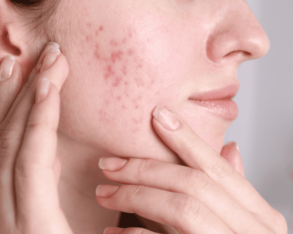 acné hormonal