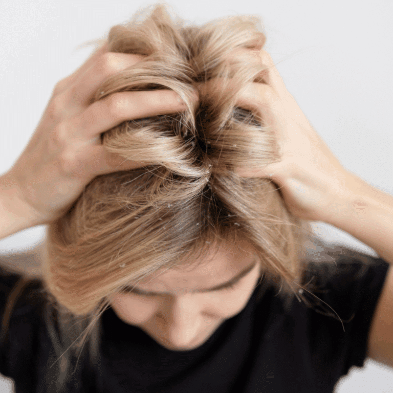 perte de cheveux